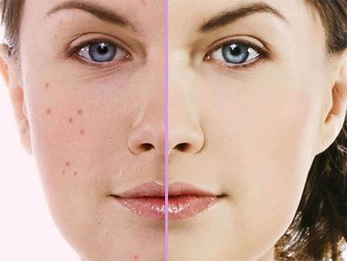 Trắng Da Sau Mụn: Làm Mờ Thâm – Làm Sáng Tự Nhiên